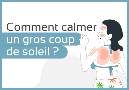 Comment calmer un gros coup de soleil ?